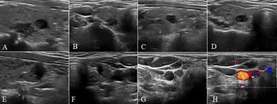 Related factor analysis for predicting large-volume central cervical lymph node metastasis in papillary thyroid carcinoma